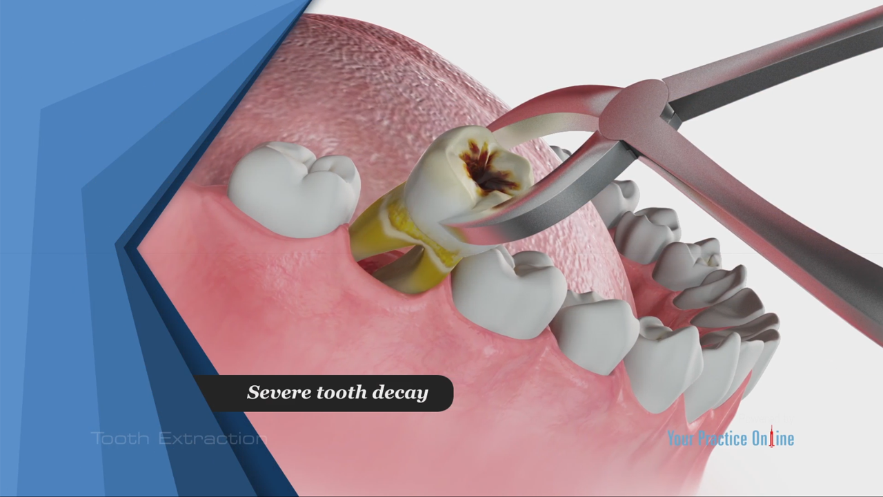 Tooth Extractions | Dentist in Las Vegas, NV